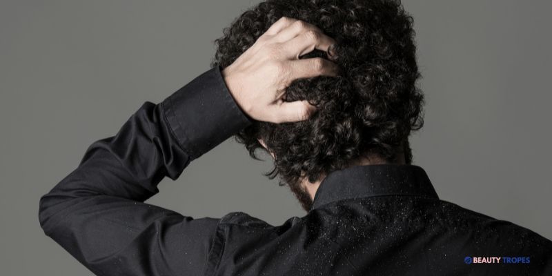 Dandruff